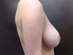Side View, Breast Reduction, Before