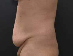 Before Skin Only Tummy Tuck Side - male
