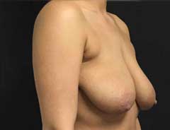 Angle view, breast lift, before