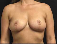 Front view, breast lift, after