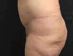 After Extended Tummy Tuck side