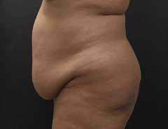 Before Extended Tummy Tuck side