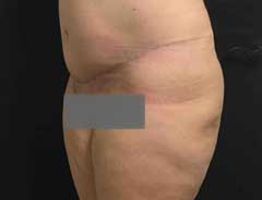 After Extended Tummy Tuck tween