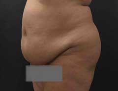 Before Extended Tummy Tuck tween