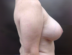 Side view, breast reduction, before