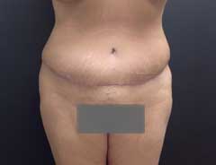After Extended Tummy Tuck front
