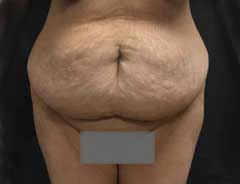 Before Extended Tummy Tuck front