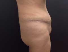 After Extended Tummy Tuck side