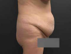 Before Extended Tummy Tuck side