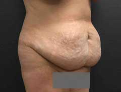 Before Extended Tummy Tuck tween