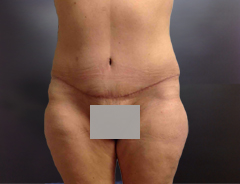 Full Tummy tuck after front