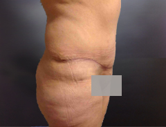 Full Tummy tuck after side