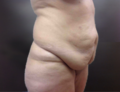 Full Tummy tuck before angle