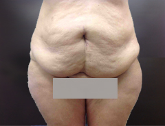 Full Tummy tuck before front