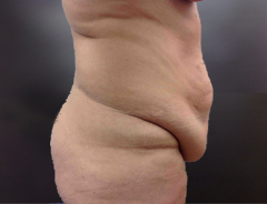 Full Tummy tuck before side