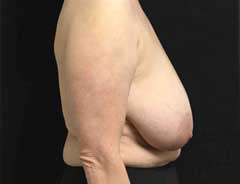 Side view, breast lift, before