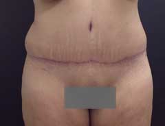 After Extended Tummy Tuck front