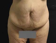 Before Extended Tummy Tuck front