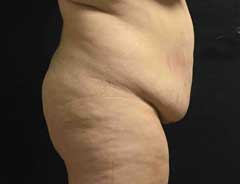 Before Extended Tummy Tuck side