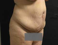 Before Extended Tummy Tuck tween