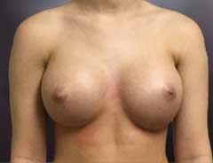 After Gel Implants front