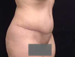Angle view, tummy tuck full, after