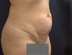 Angle view, tummy tuck full, before