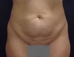 Front view, tummy tuck full, before