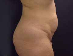 Side view, tummy tuck full, before