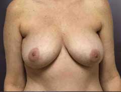 After Gel Implants front