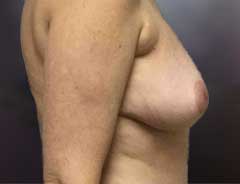 After Gel Implants side