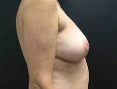 Before Saline Implants side