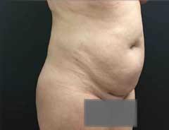 Angle view, tummy tuck full, before