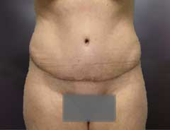 Front view, tummy tuck full, after