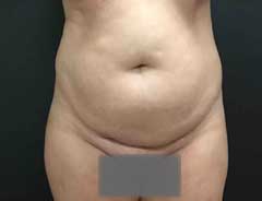 Front view, tummy tuck full, before