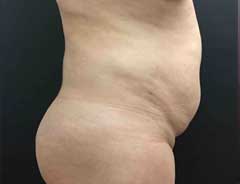 Side view, tummy tuck full, before