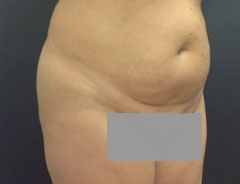 Tummy Tuck, Full, Angle, Before