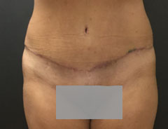 Tummy Tuck, Full, Front, After
