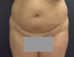 Tummy Tuck, Full, Front, Before