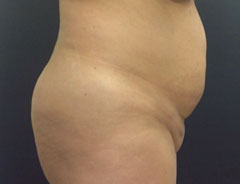 Tummy Tuck, Full, Side, Before