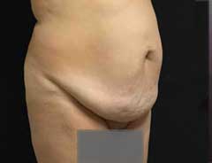 Angle view, tummy tuck extended, before