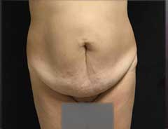 Front view, tummy tuck extended, before