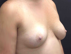 Angle view, breast augmentation before: 36B