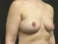 Angle view, breast lift, after