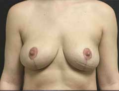 Front view, breast lift, after