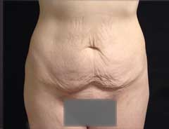 Front view, tummy tuck full, before