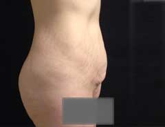 Side view, tummy tuck full, before