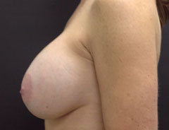 Breast Aug, Side, 32D
