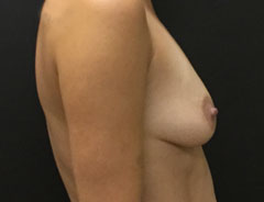 Breast Aug, Side, 34B