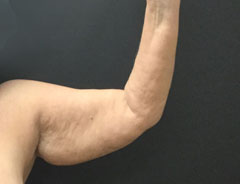 Upper Arm Lift Left Arm Before Surgery